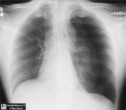 Tension Pneumothorax